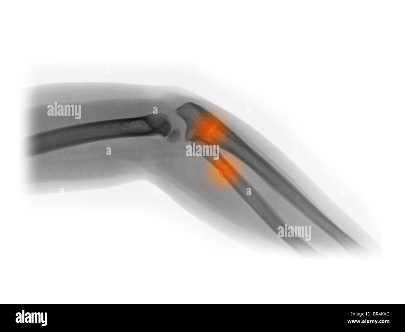 elbow x-ray of a 4 year old girl who fractured her proximal radius and ulna Stock Photo