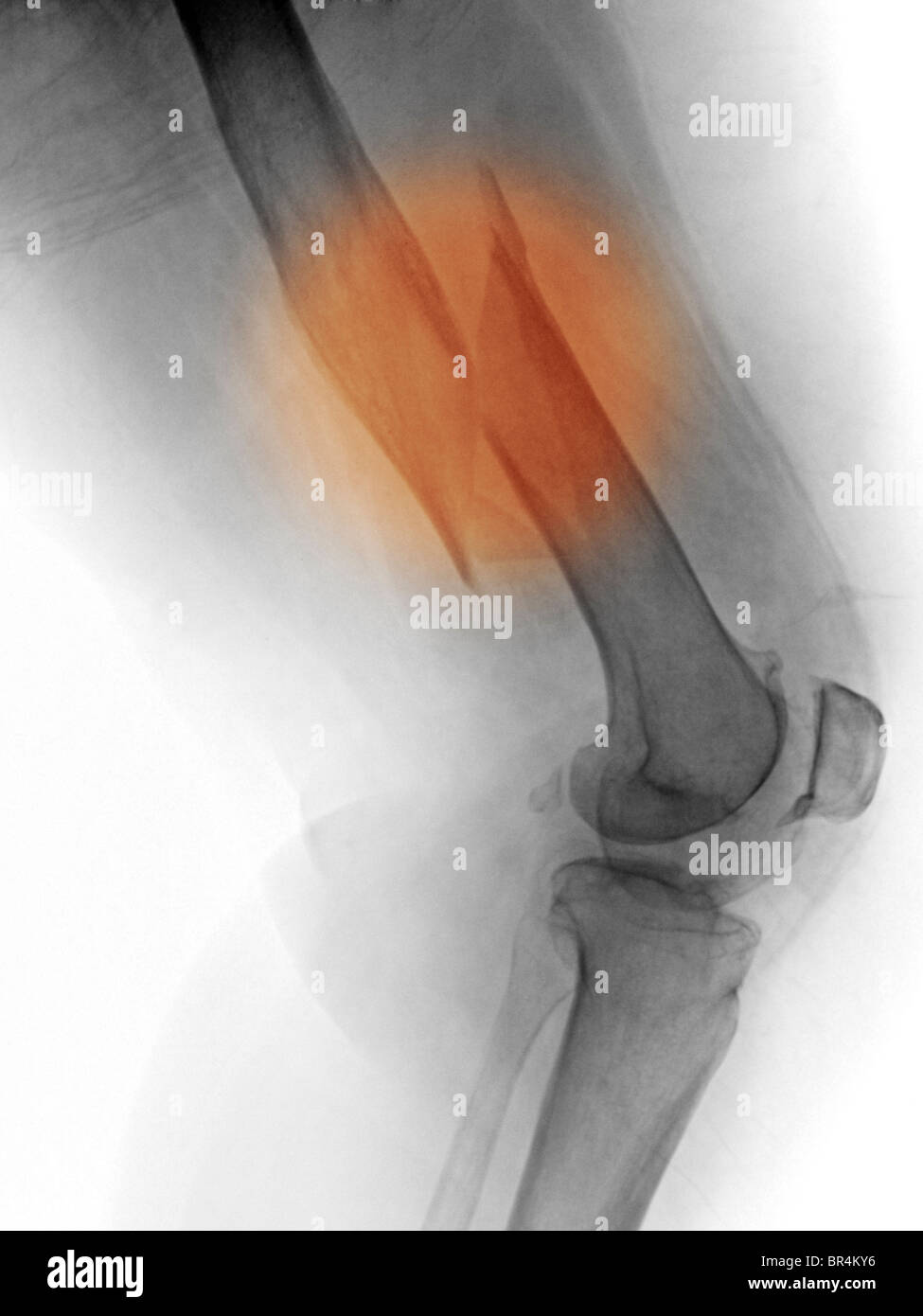 leg x-ray of a 67 year old female who fell and fractured her femur Stock Photo
