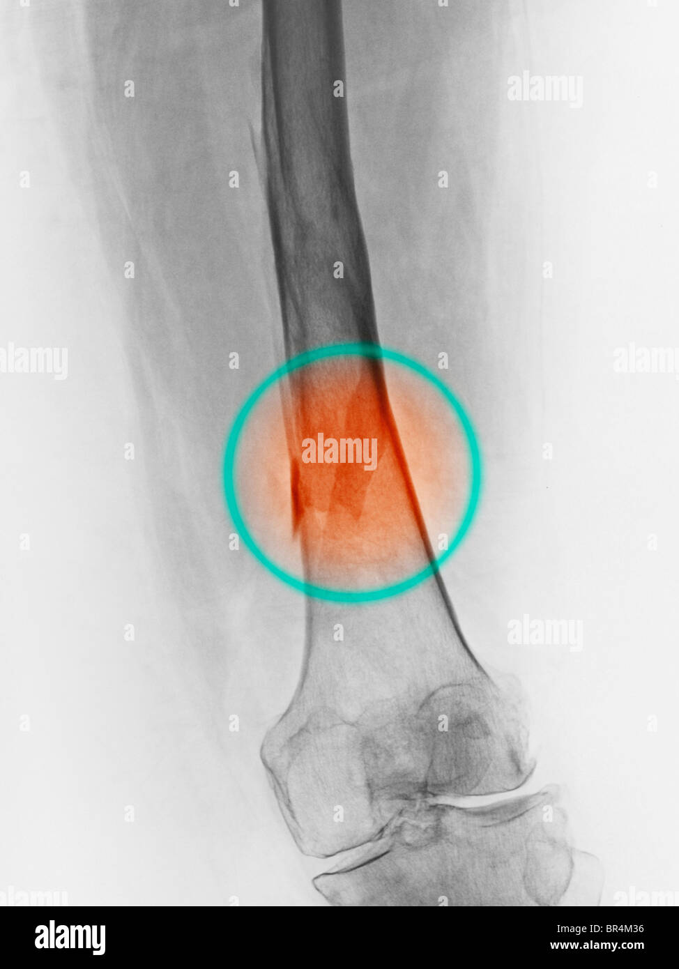 leg x-ray of a 67 year old female who fell and fractured her femur Stock Photo