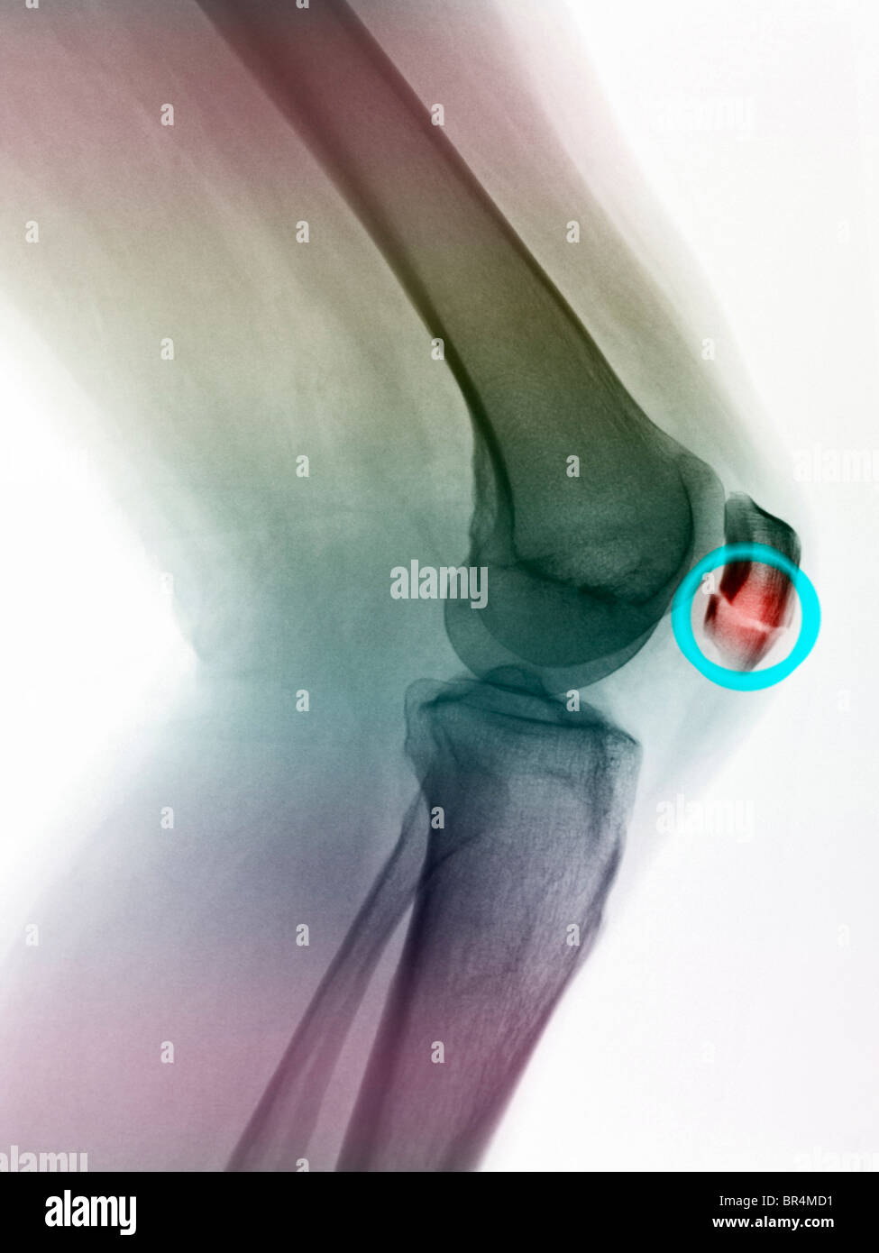 x-ray of the knee of a 55 year old woman showing a fractured kneecap Stock Photo