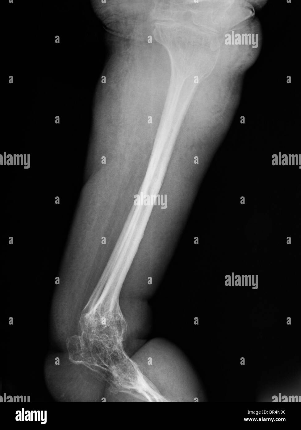 leg and foot x-ray of a 63 year old man with paraplegia and extensive degenerative changes and osteopenia Stock Photo