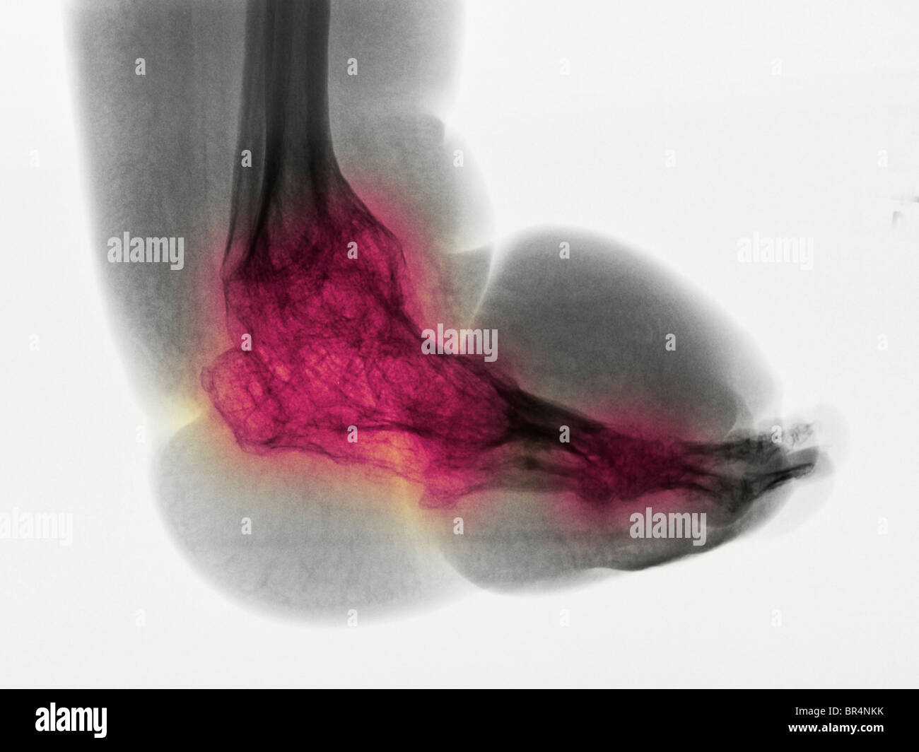 leg and foot x-ray of a 63 year old man with paraplegia and extensive degenerative changes and osteopenia Stock Photo