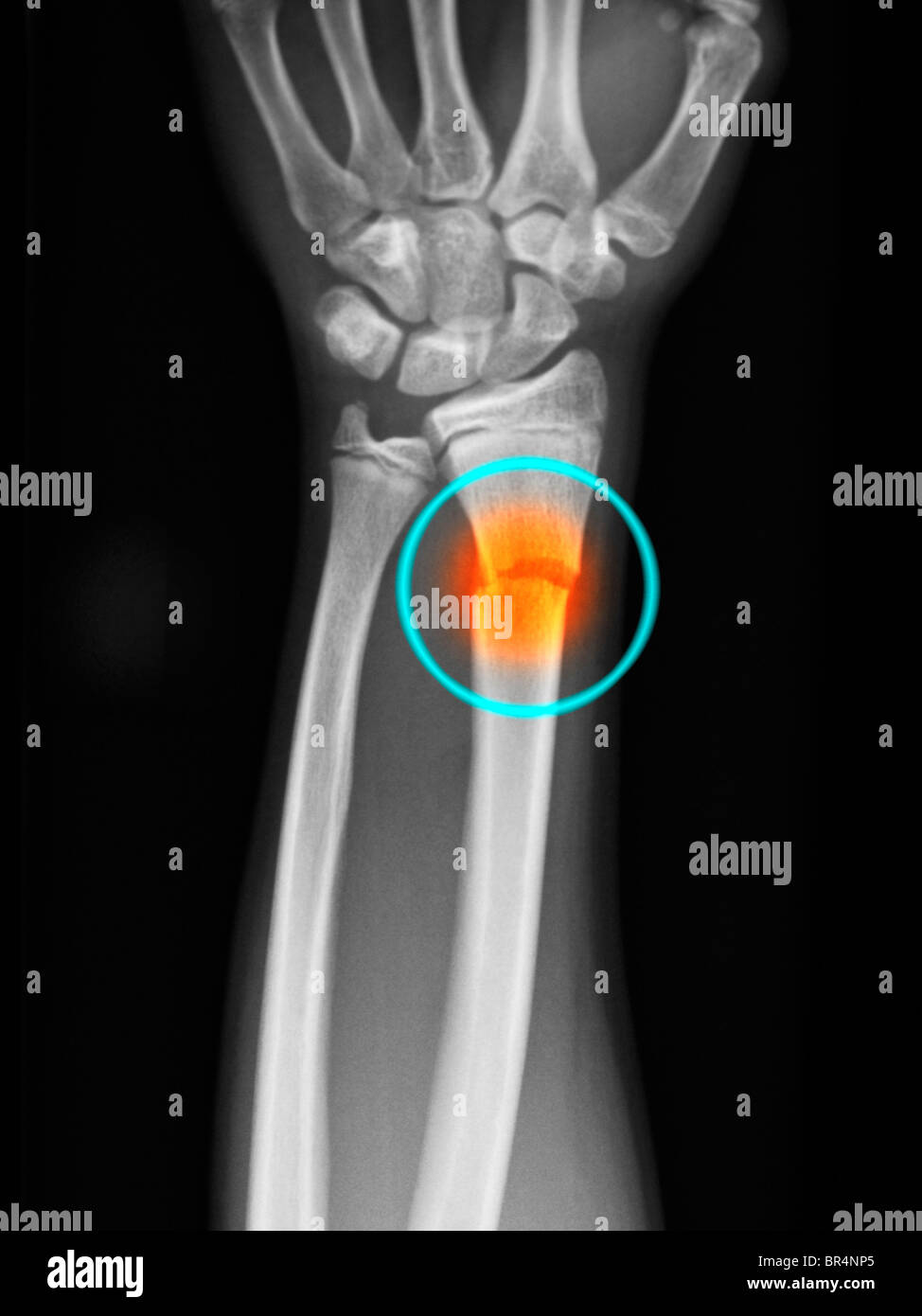 forearm x-ray showing a distal radius fracture in a 14 year old boy Stock Photo