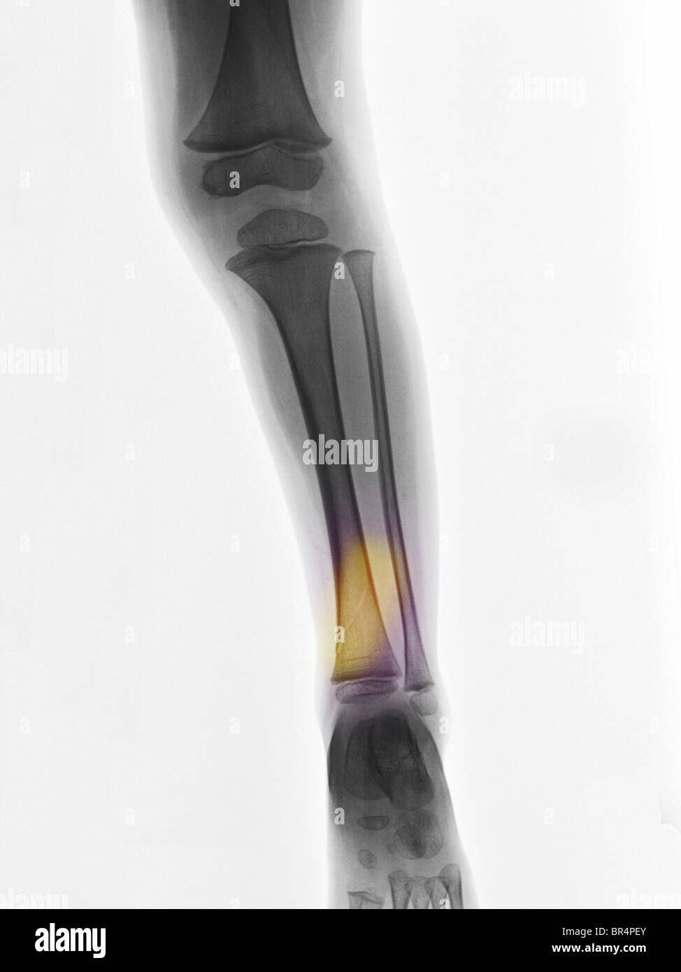 Leg xray showing a distal tibia fracture in a 2 year old boy Stock