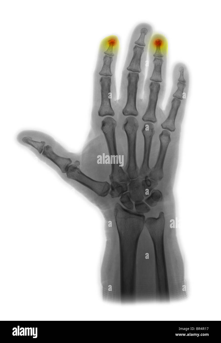 hand xray showing crushed fingertips, hand xray showing fractures of