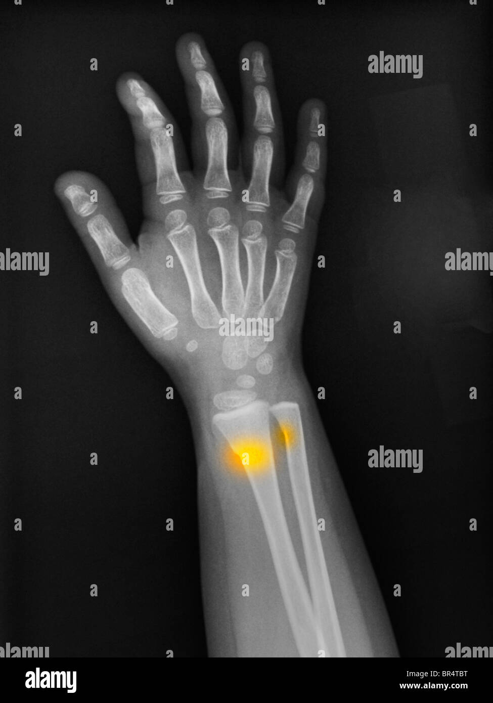 forearm x-ray of a 3 year old girl showing a buckle, greenstick, fracture of the distal radius and ulna Stock Photo