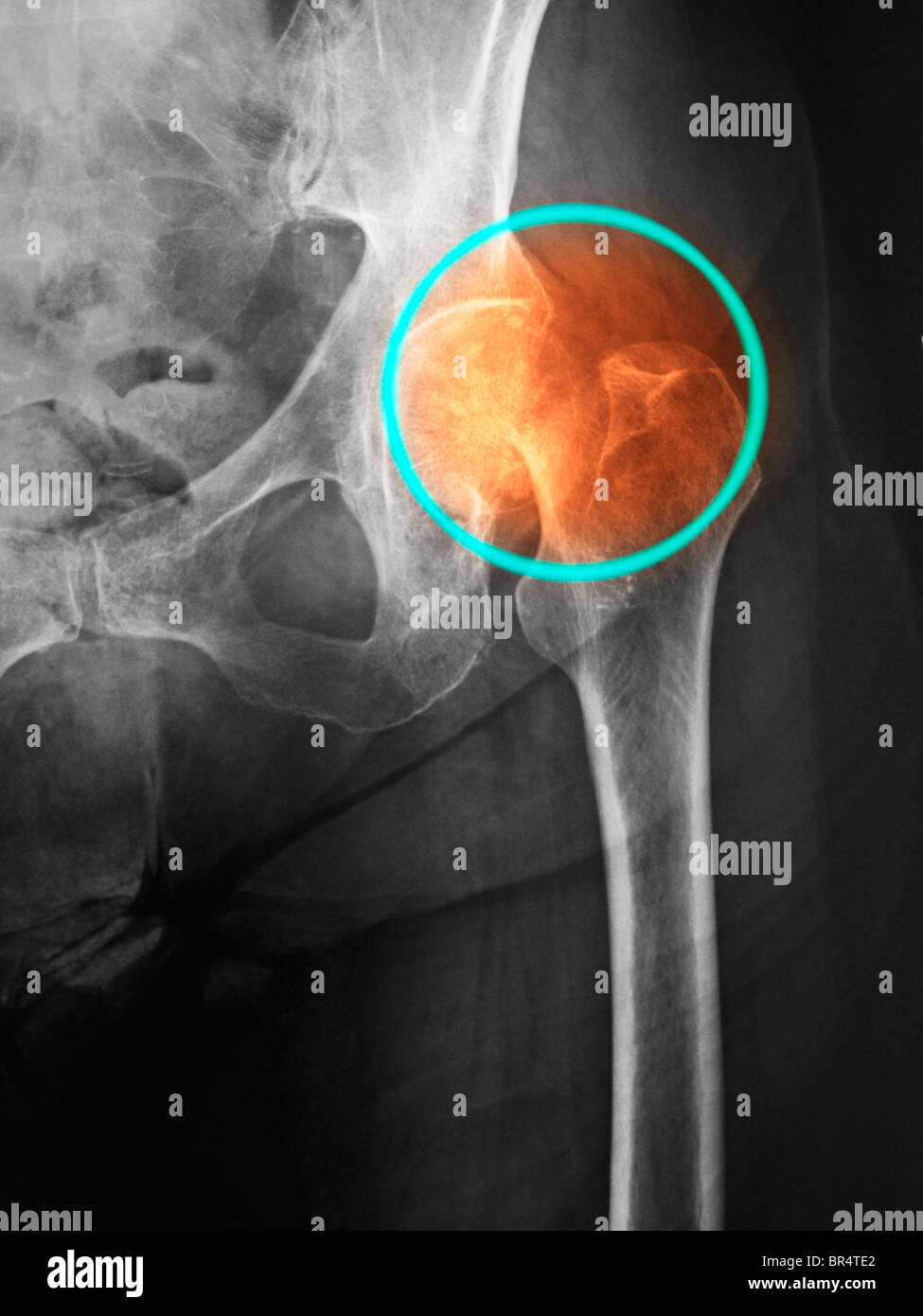 xray of a hip fracture in a 85 year old man, Hip fracture in an 85