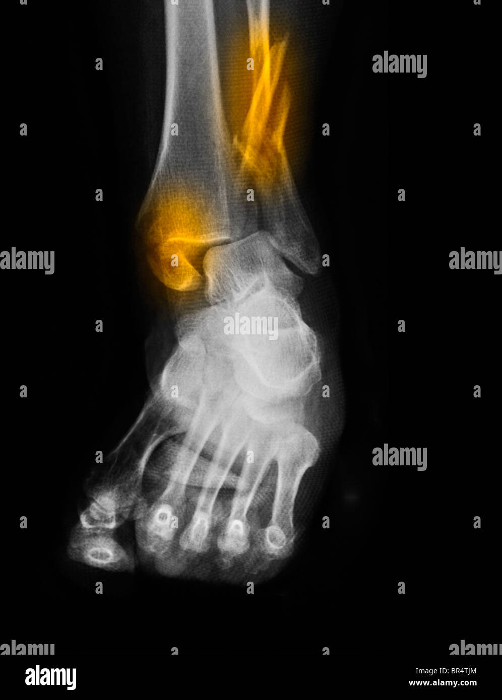 x-ray showing a fracture and dislocation of the ankle in a 64 year old man. Stock Photo