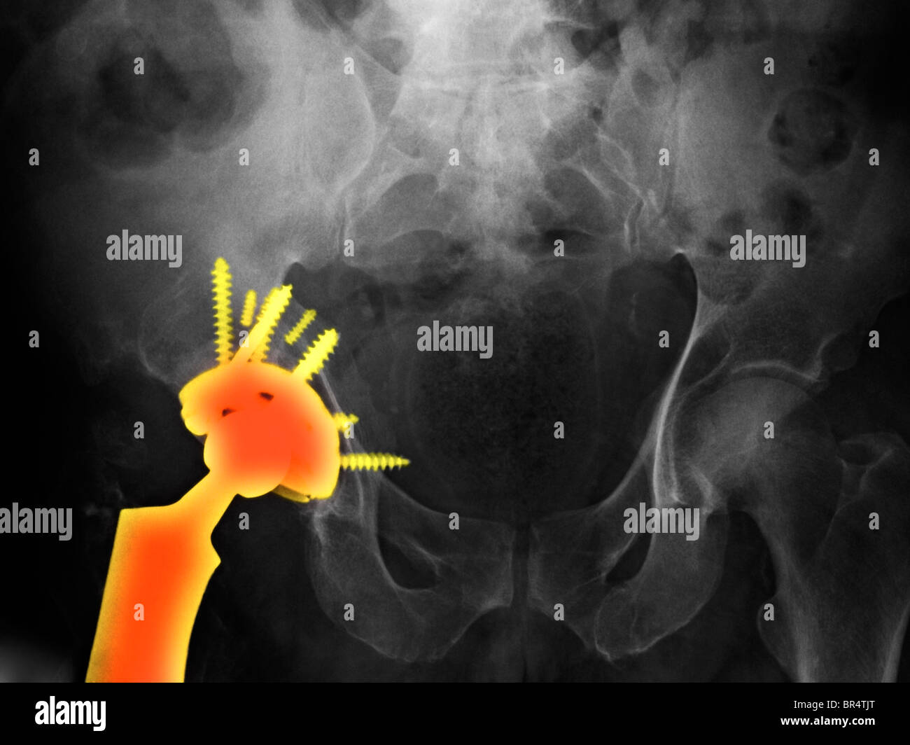 x-ray showing a hip replacement in a 56 year old man Stock Photo