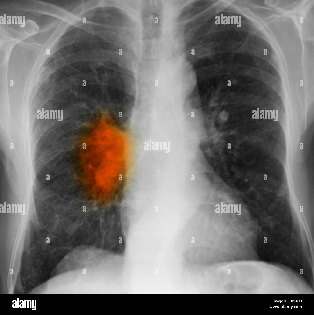 x-ray showing lung cancer in an 80 year old man with a long history of smoking Stock Photo