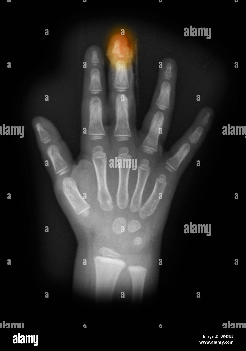 x-ray showing a crush injury to the middle fingertip of a 3 year old girl whose finger was caught in a door Stock Photo