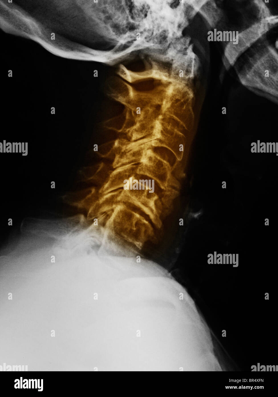 xray showing degenerative arthritis of the neck in a 77 year old Stock