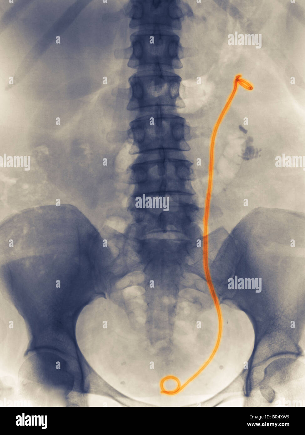 x-ray showing a stent from the kidney to the bladder of a 46 year old woman who had a history of kidney stones Stock Photo