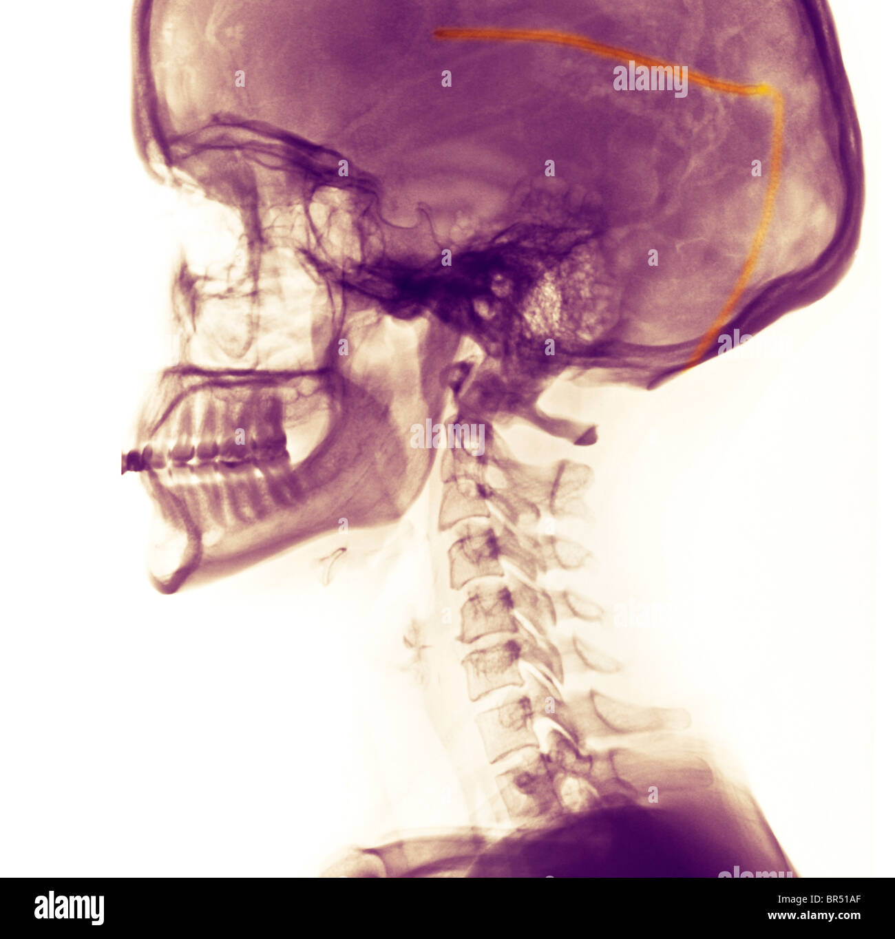 x-ray of the skull of a 27 year old female with a ventricular shunt in the brain for the treatment of hydrocephalus Stock Photo