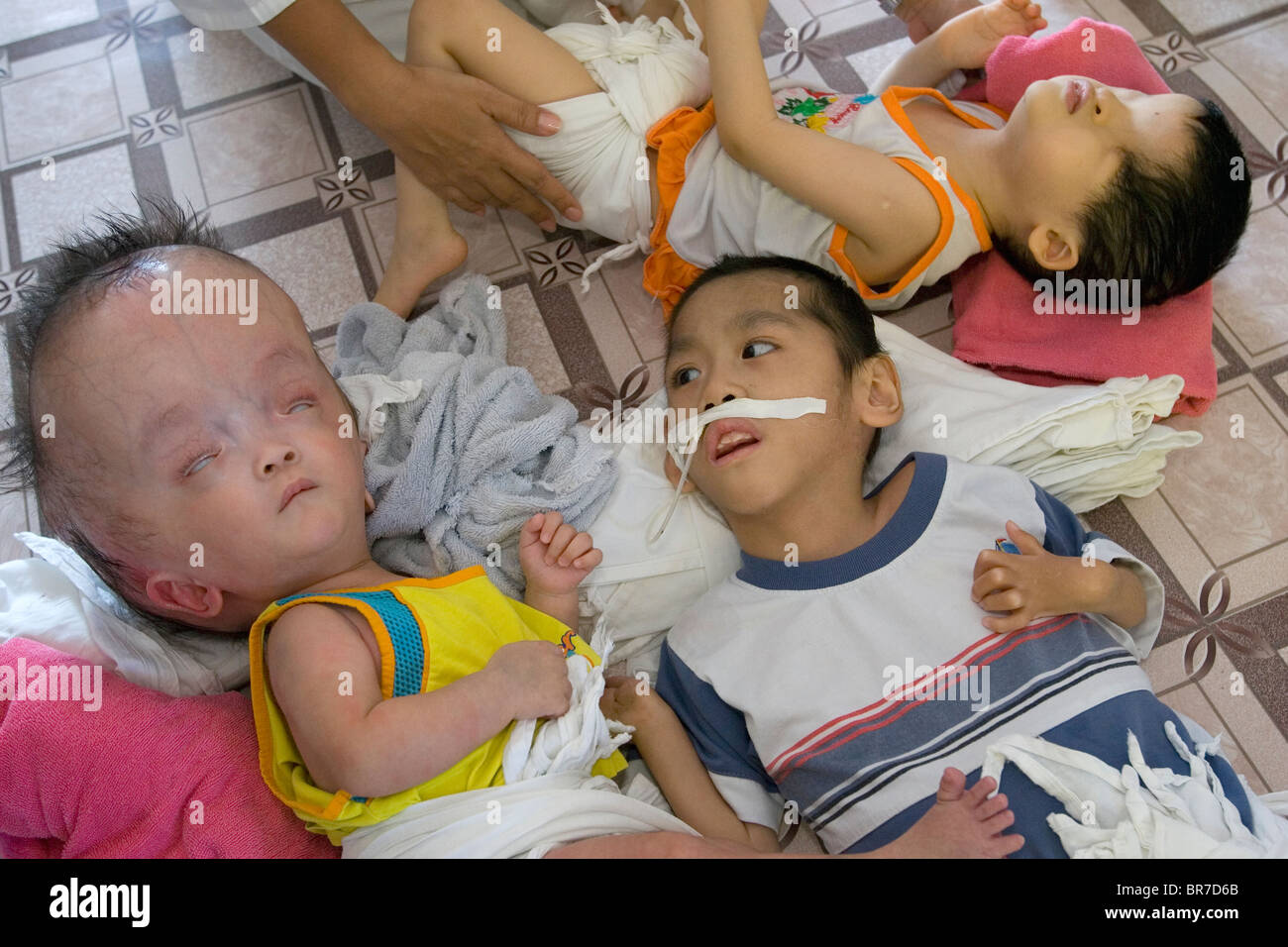 Agent Orange Birth Defects