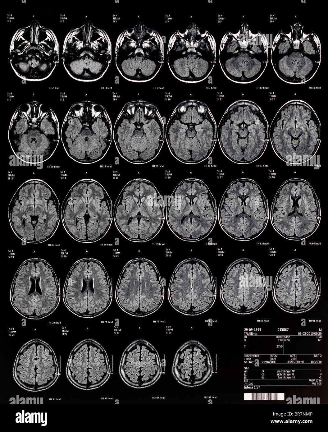 children's Brain MRI magnetic resonance  imaging  or   NMRI nuclear magnetic resonance imaging of Stock Photo