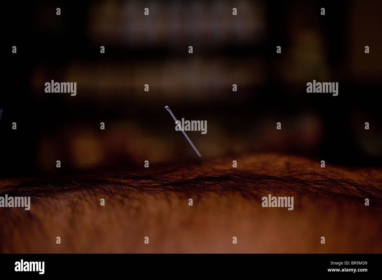 Acupuncture for smoking cessation in Wainscott, NY Stock Photo Alamy