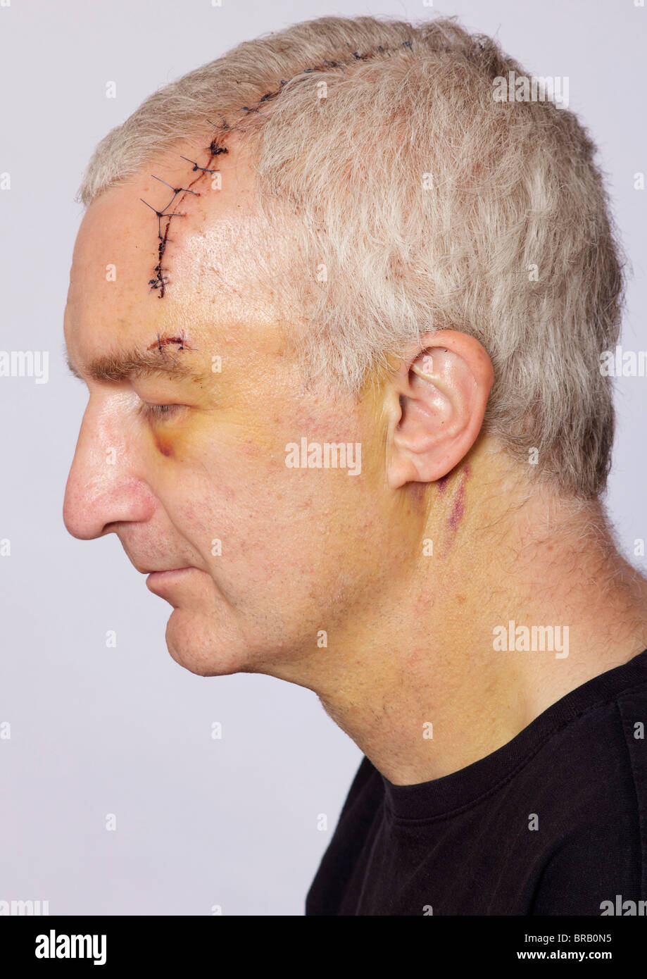 Man with long head wound and stitches Stock Photo