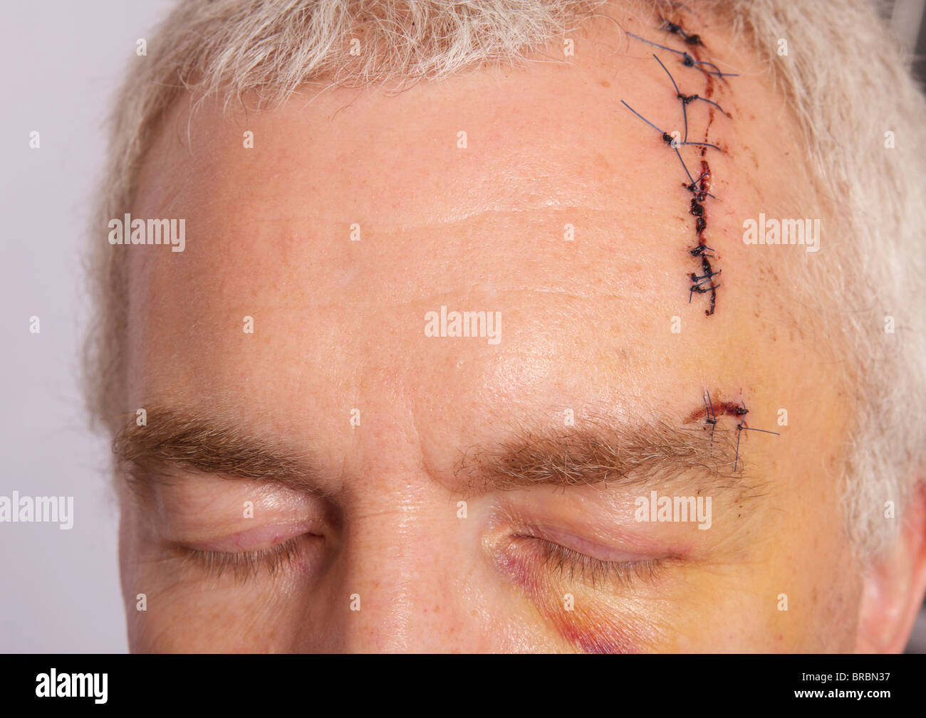 Man with long head wound and stitches Stock Photo