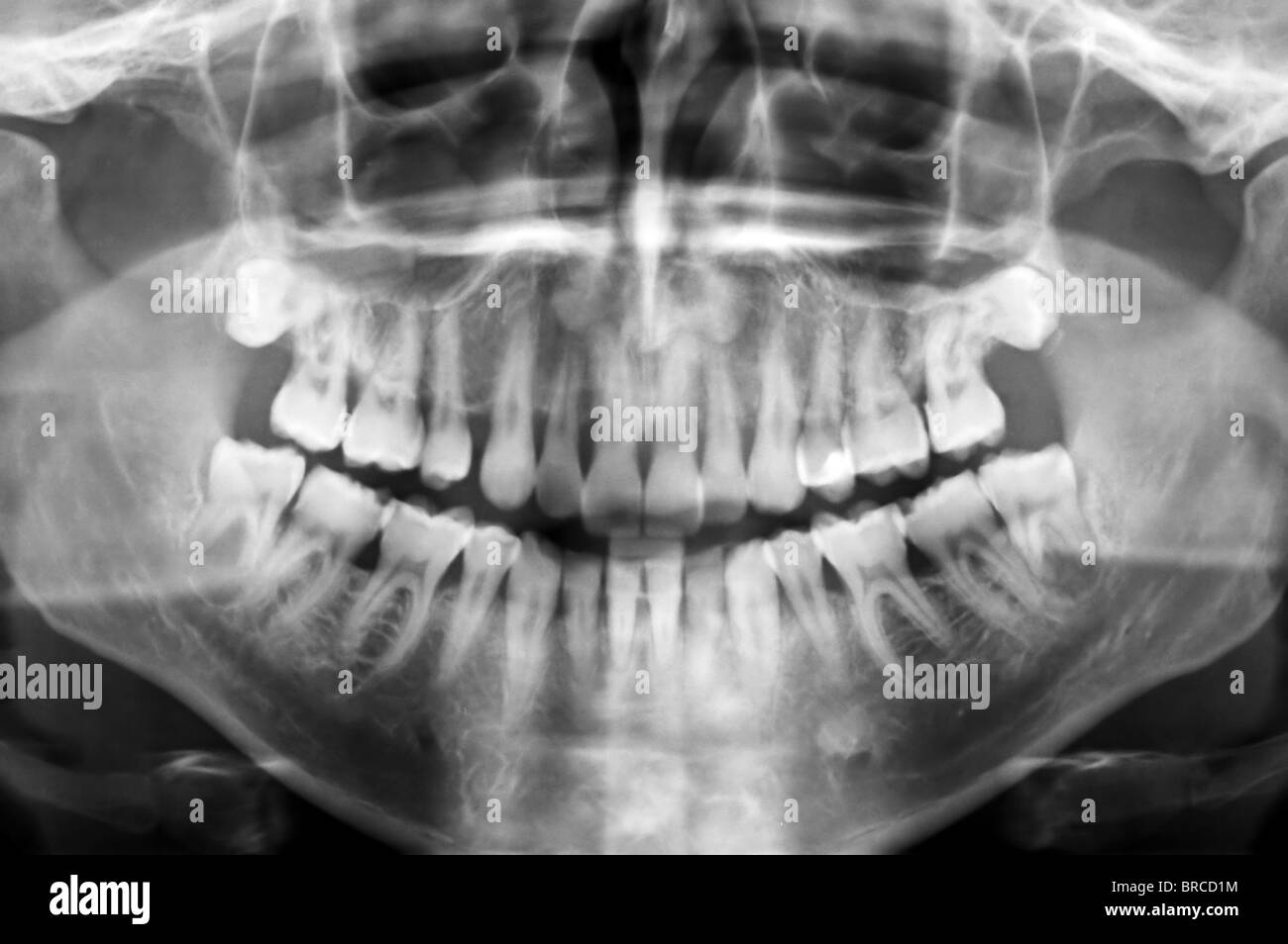 Dental scan x-ray of a 35 year old man. Stock Photo