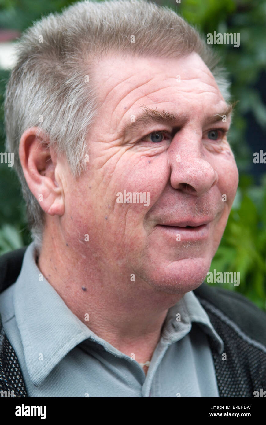 Broken nose man with disfigured face due to missed hospital appointments London UK  2010s HOMER SYKES Stock Photo