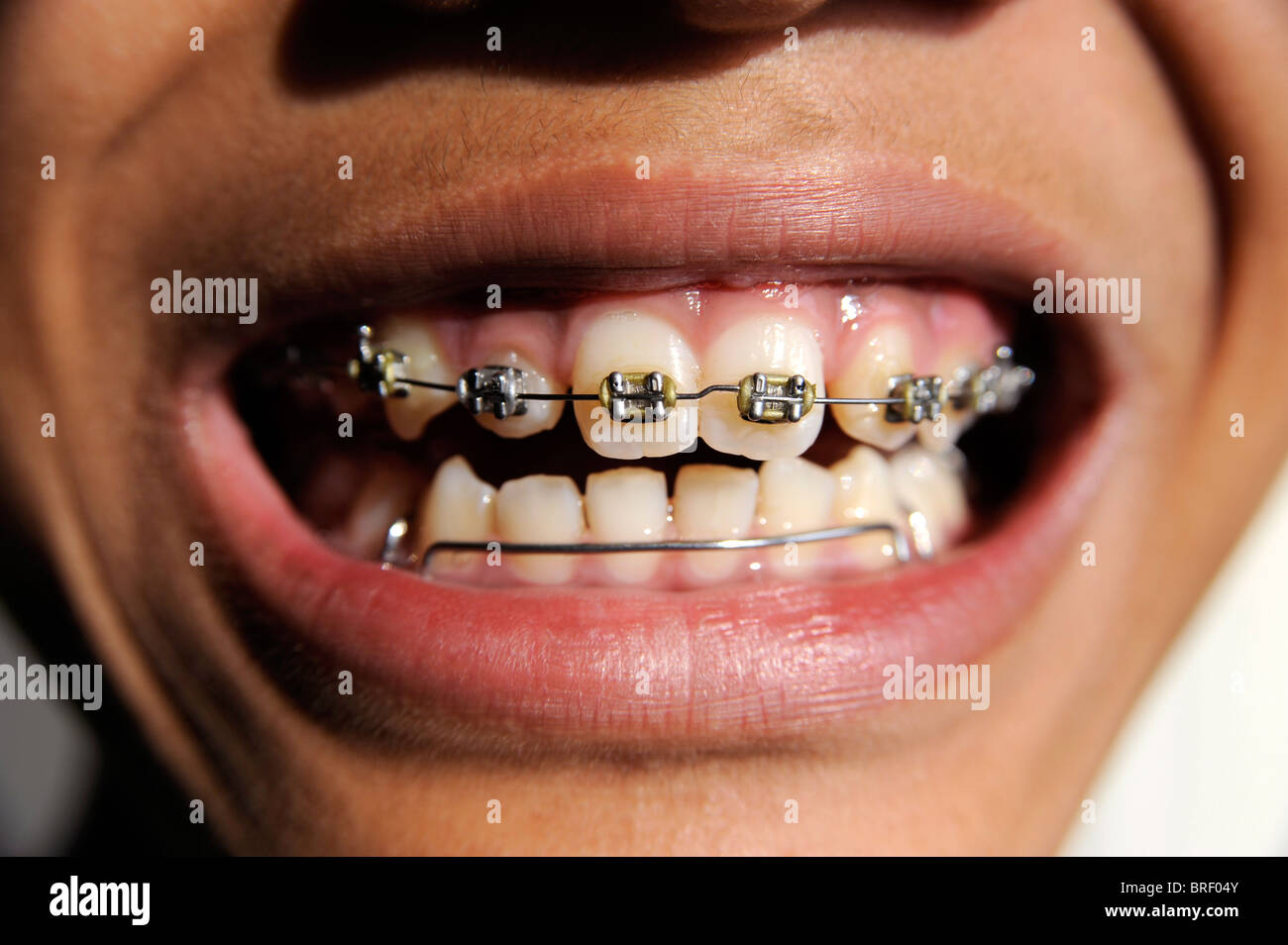 Boy with orthodontics braces,12 years old Stock Photo Alamy
