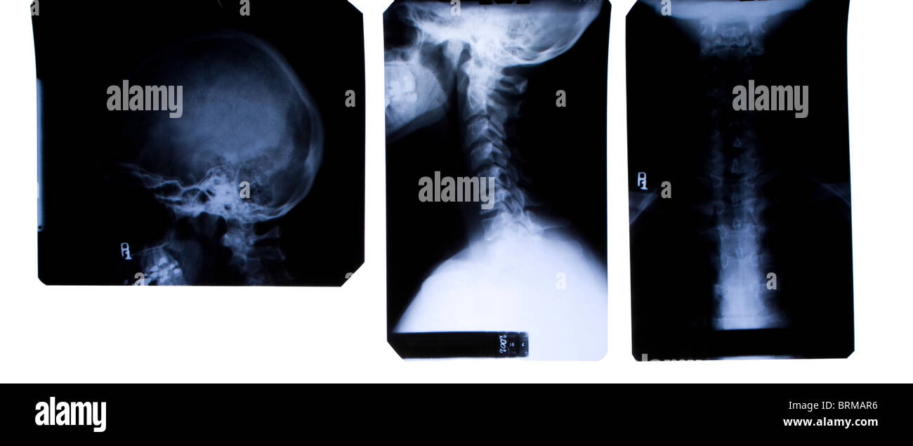 X-Ray film of neck and head - three views - front and side Stock Photo