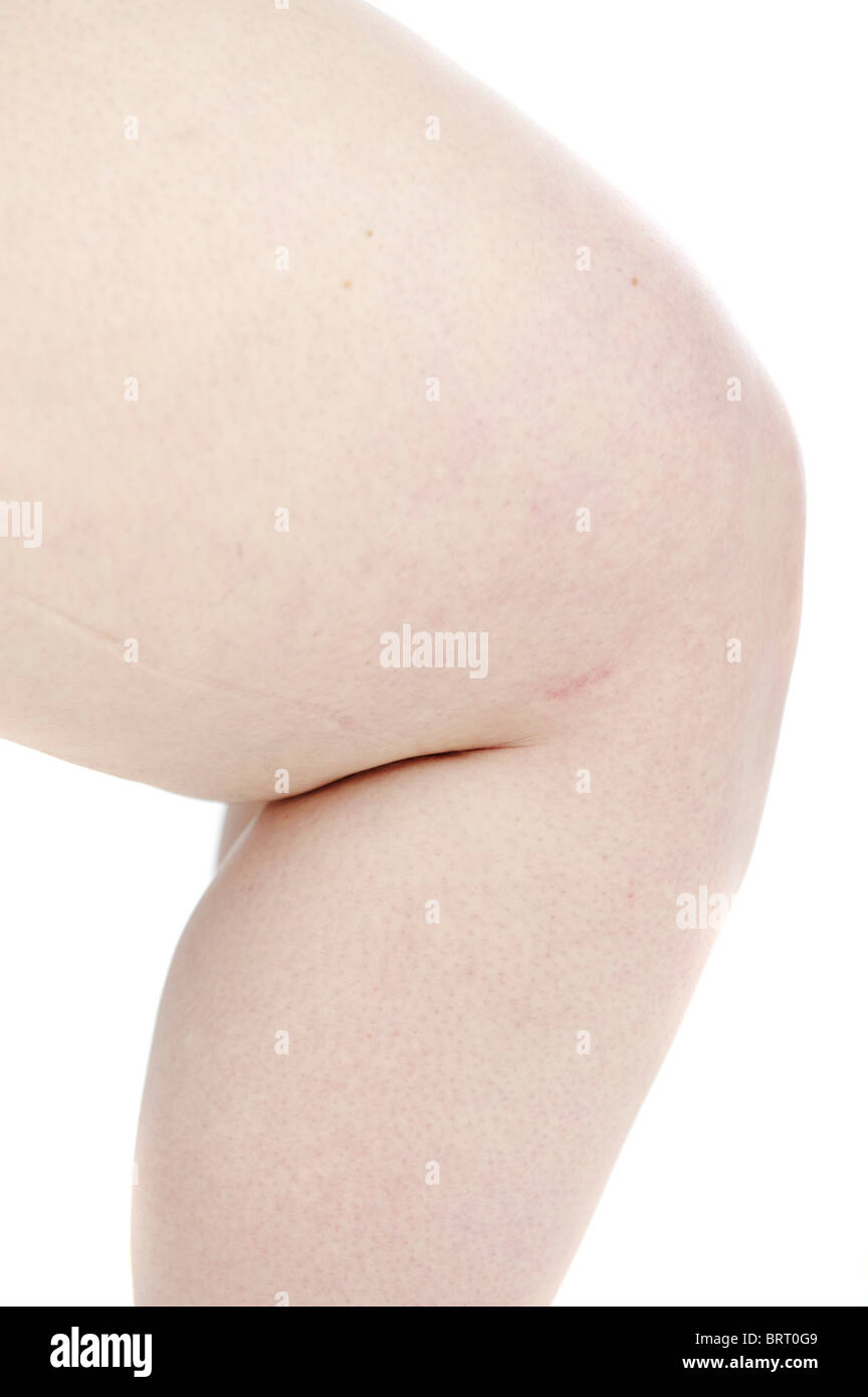 Leg of a young, fat woman Stock Photo