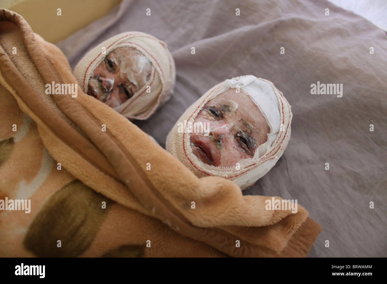 burn victims of a IED attack in Afghanistan Stock Photo