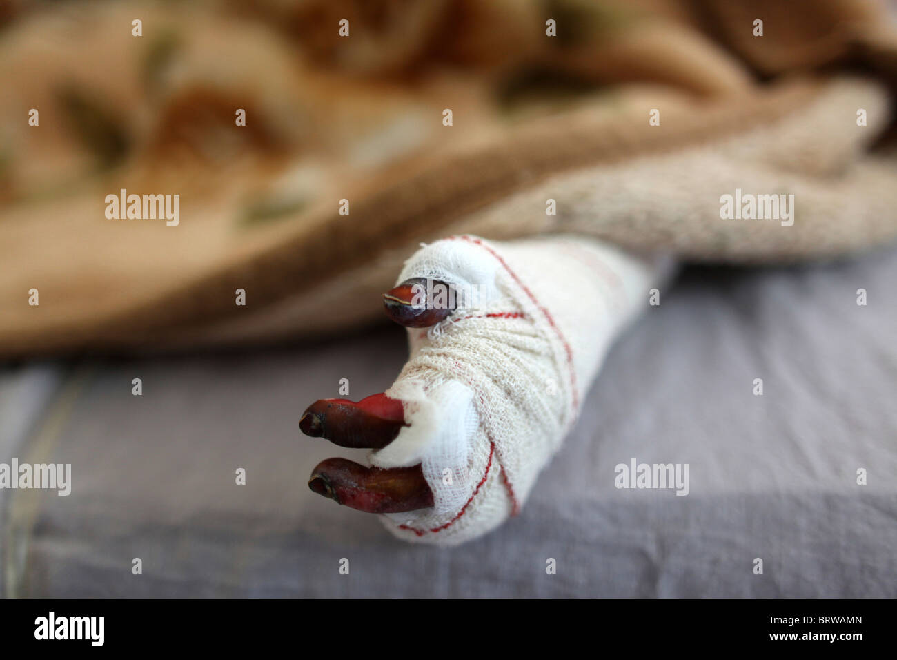 burn victims of a IED attack in Afghanistan Stock Photo