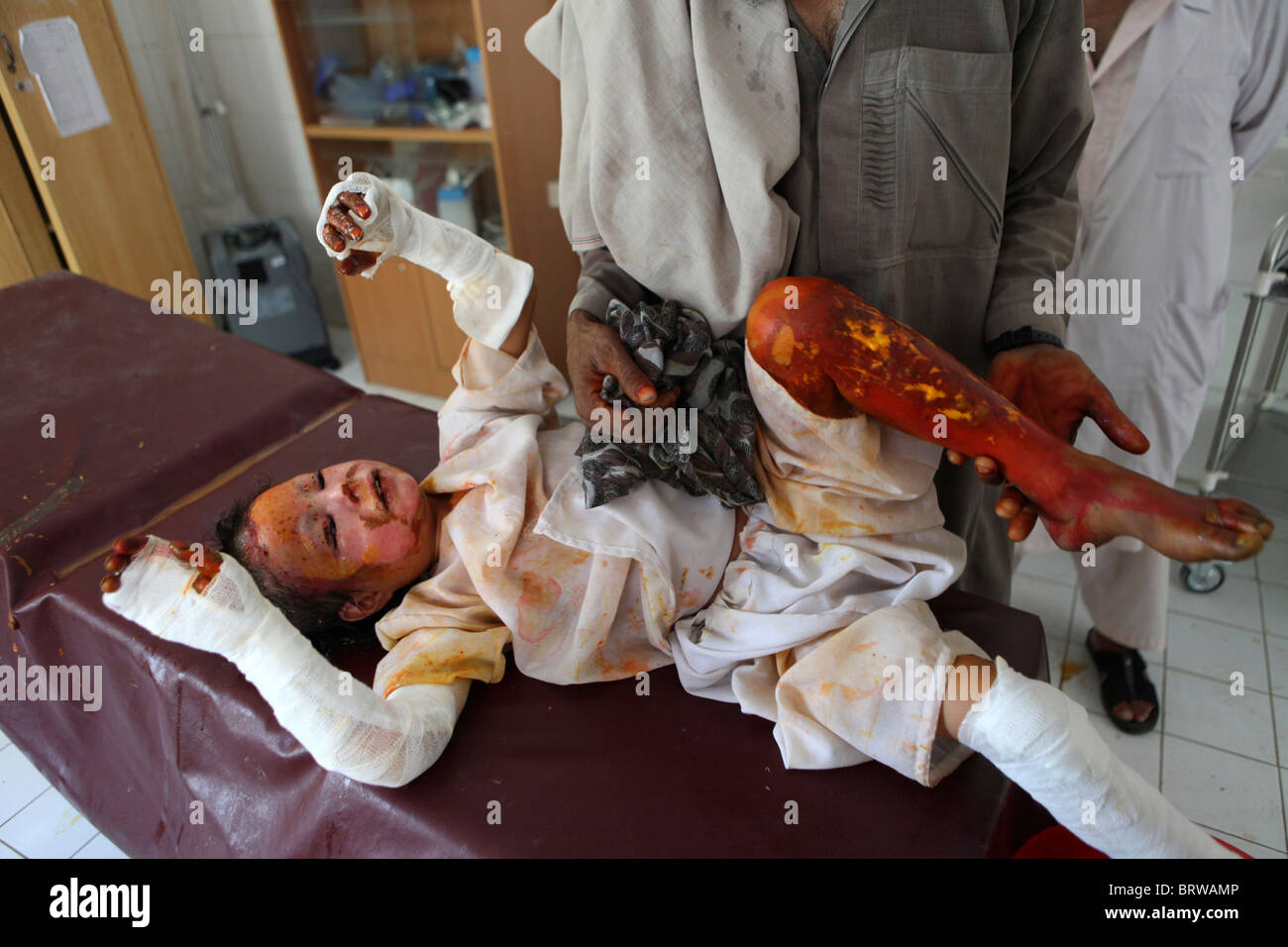 burn victims of a IED attack in Afghanistan Stock Photo