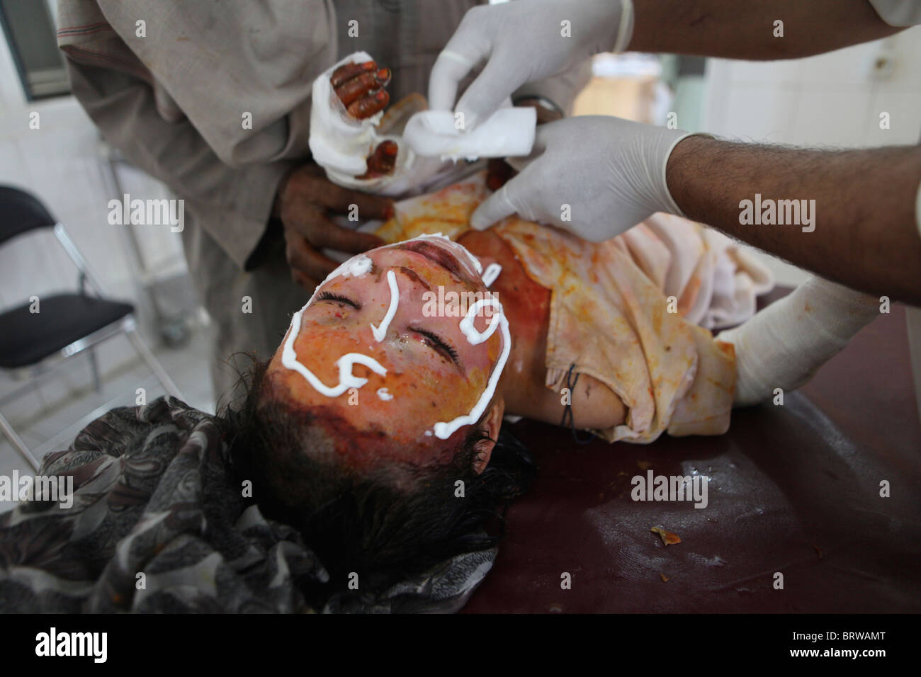 burn victims of a IED attack in Afghanistan Stock Photo