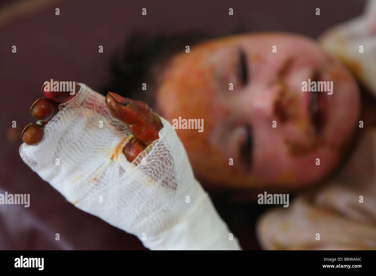 burn victims of a IED attack in Afghanistan Stock Photo