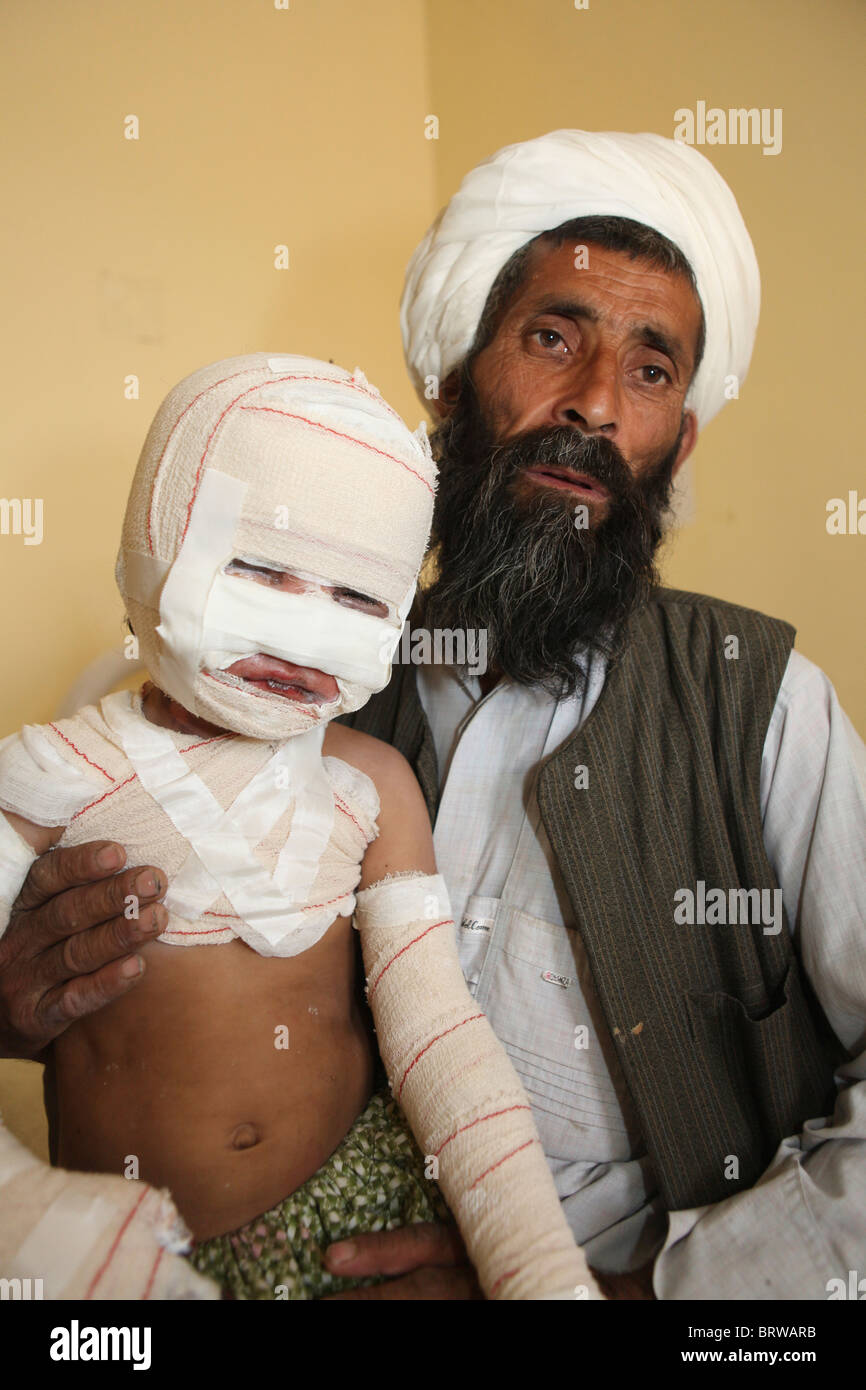 burn victims of a IED attack in Afghanistan Stock Photo