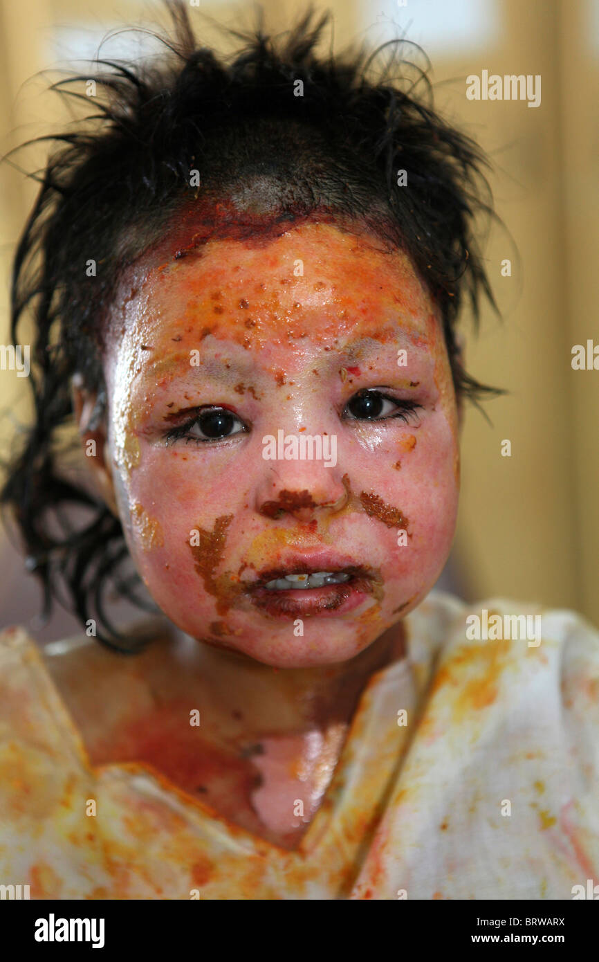 burn victims of a IED attack in Afghanistan Stock Photo