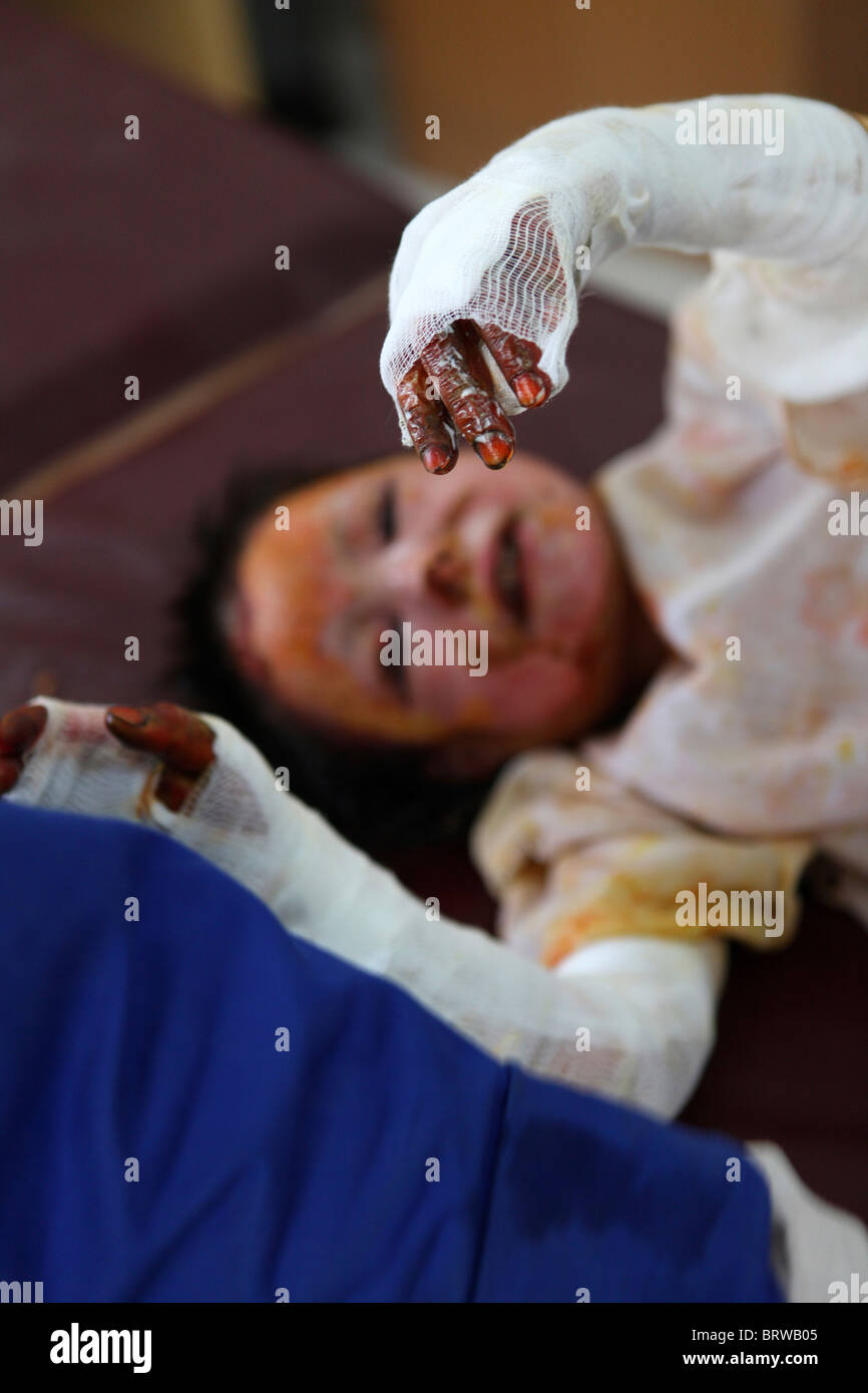 burn victims of a IED attack in Afghanistan Stock Photo