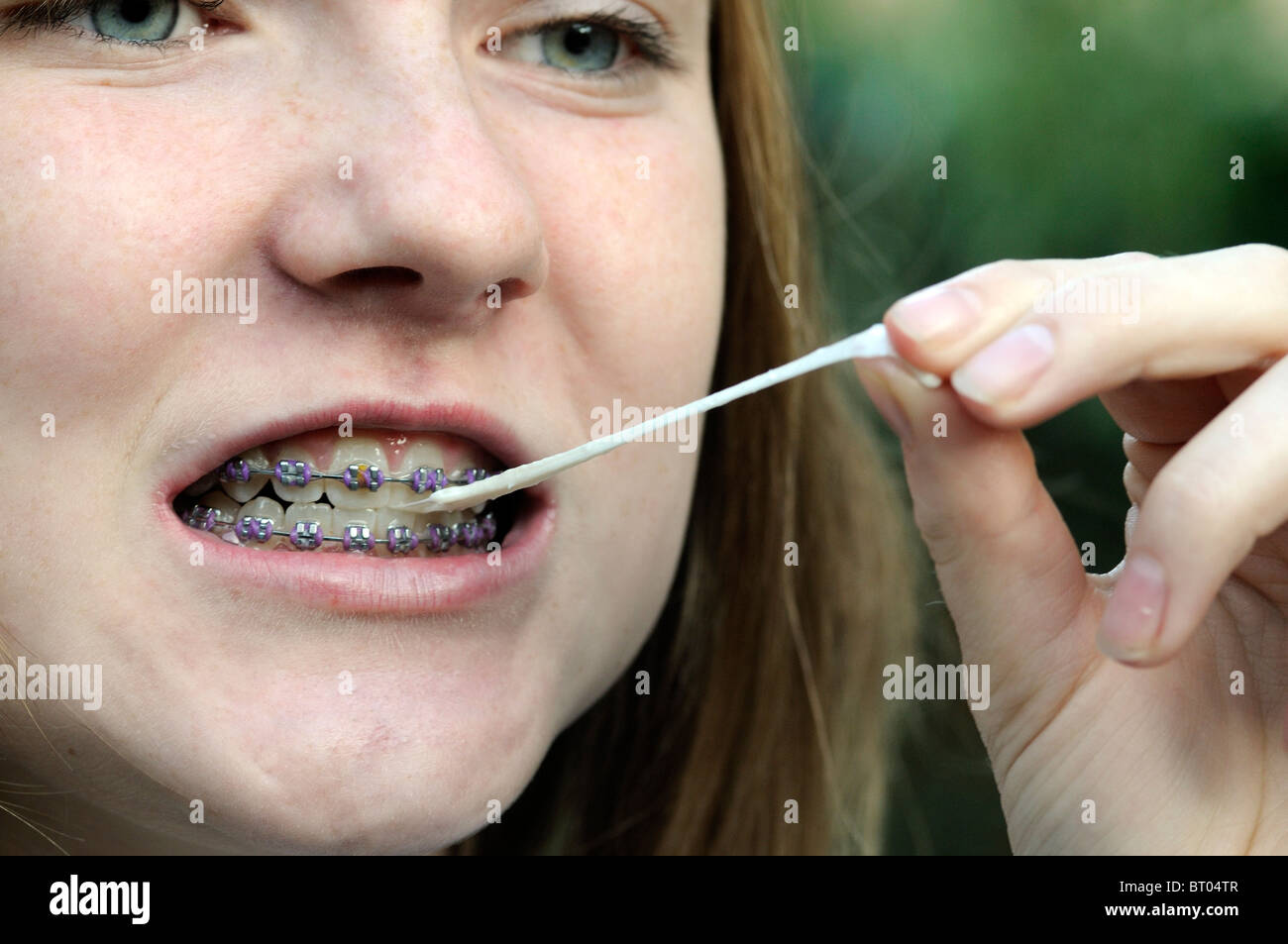 Can You Chew Gum With Braces All You Need Infos