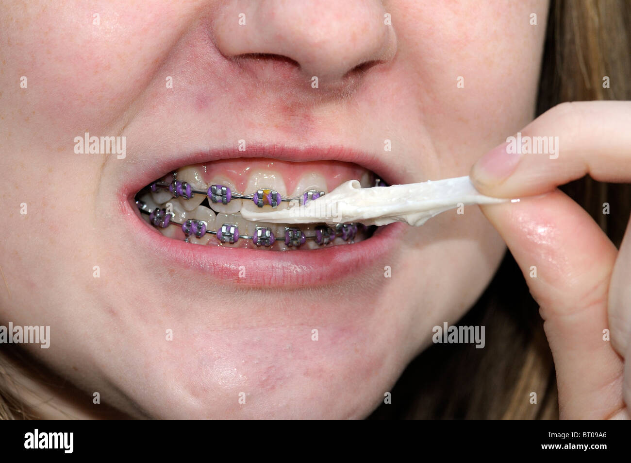 Young girl with a dental brace chewing gum Stock Photo Alamy