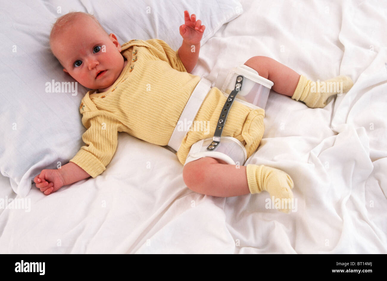 Dysplasia High Resolution Stock Photography And Images Alamy