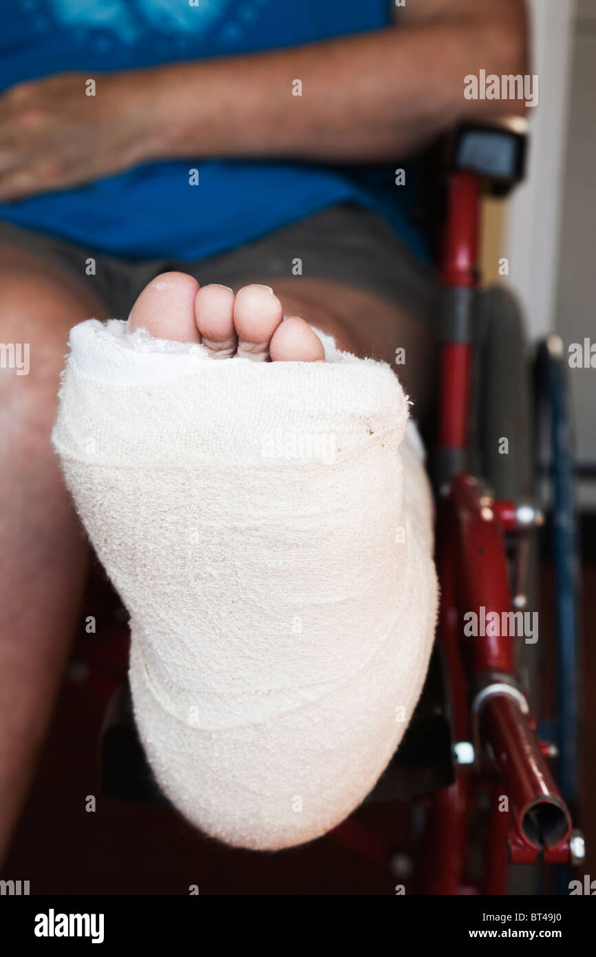 Foot view of a woman with broken ankle bones set in a 'Back Slab' plaster-cast. Stock Photo