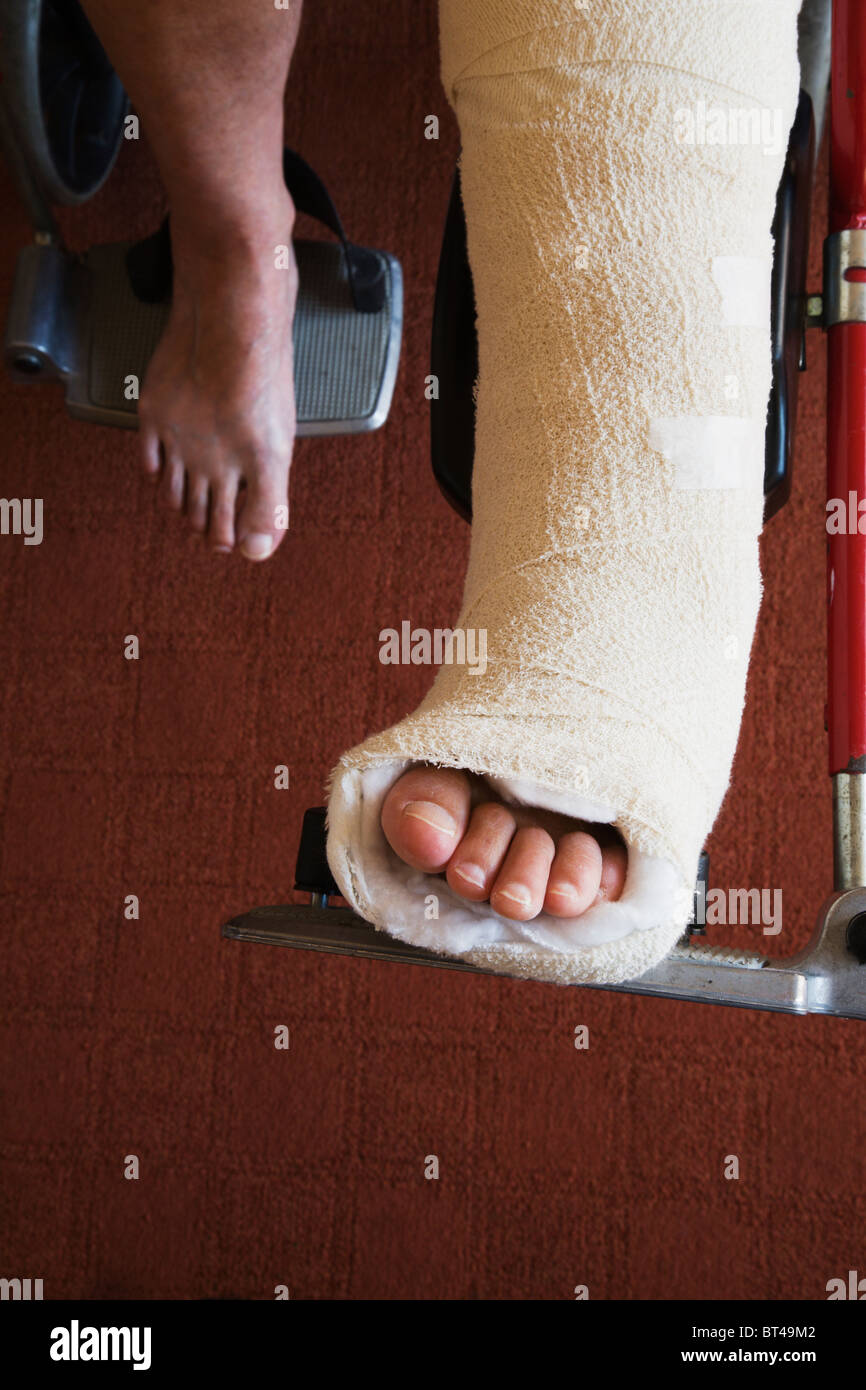 A woman with broken ankle bones set in a 'Back Slab' plaster-cast. Stock Photo