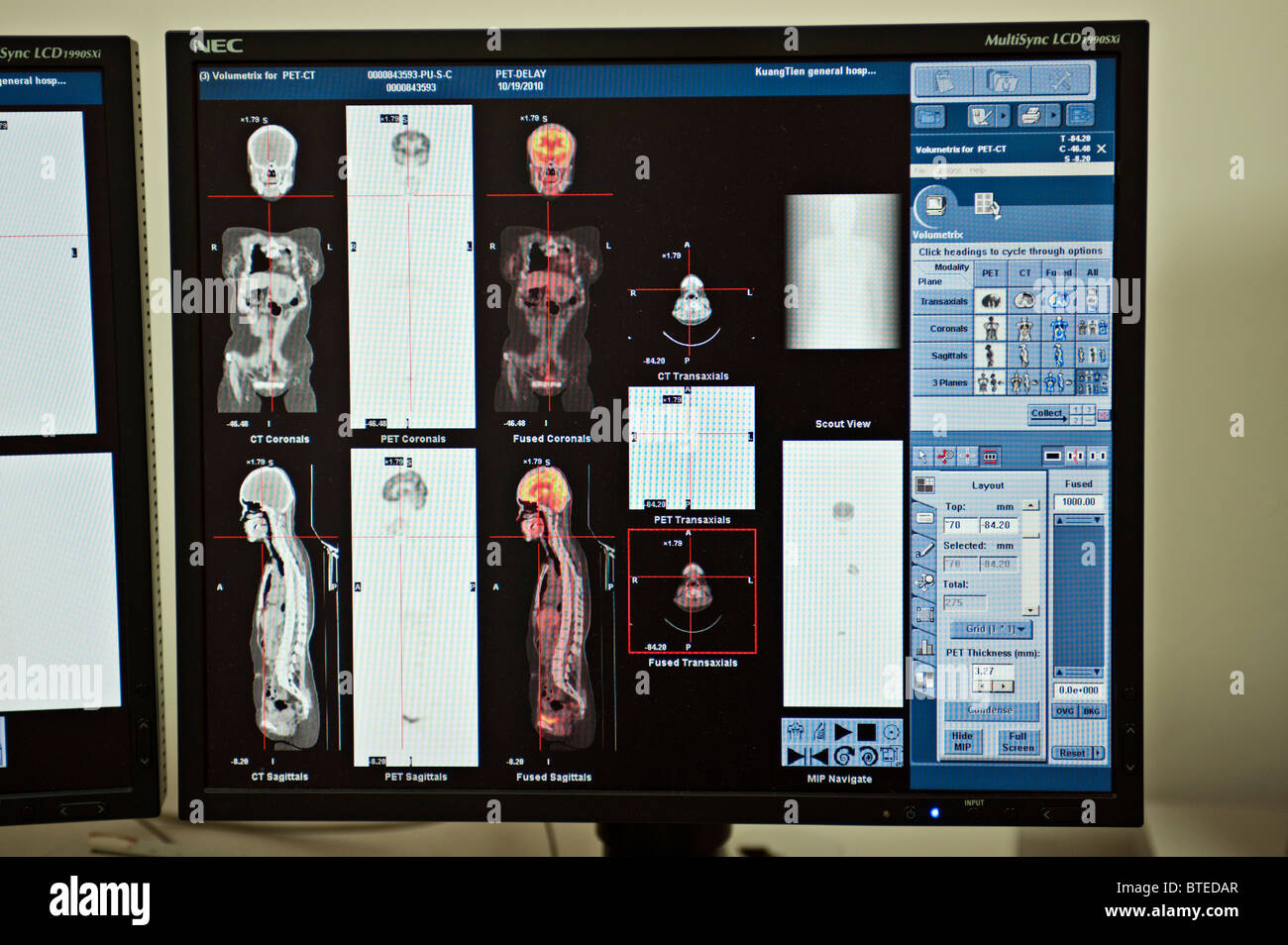 PET CT diagnostic medical scanner images on computer monitor, close up Stock Photo Alamy