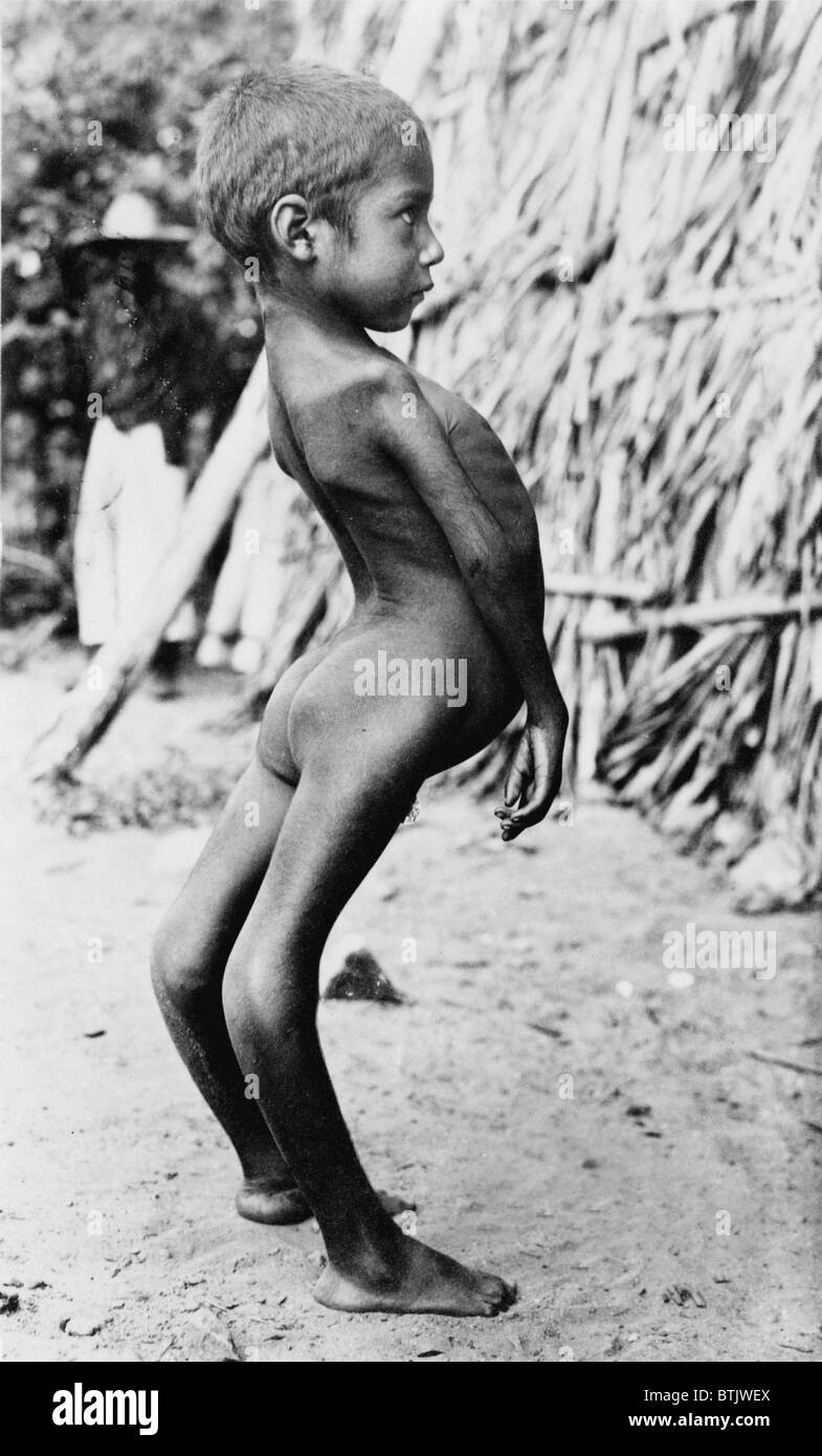 deformed kid Deformed Mexican boy, original title: 'Freak Mexican Boy', Photograph by  A.R. Alexander, circa 1915 Stock Photo - Alamy