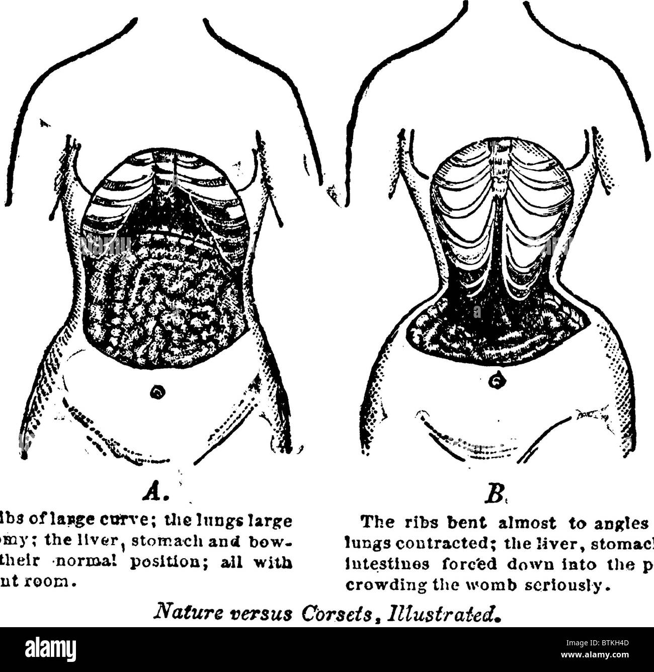 'Nature Versus Corsets.' At left is the natural arrangement of a woman's internal anatomy, contrasted with the corset's effects Stock Photo