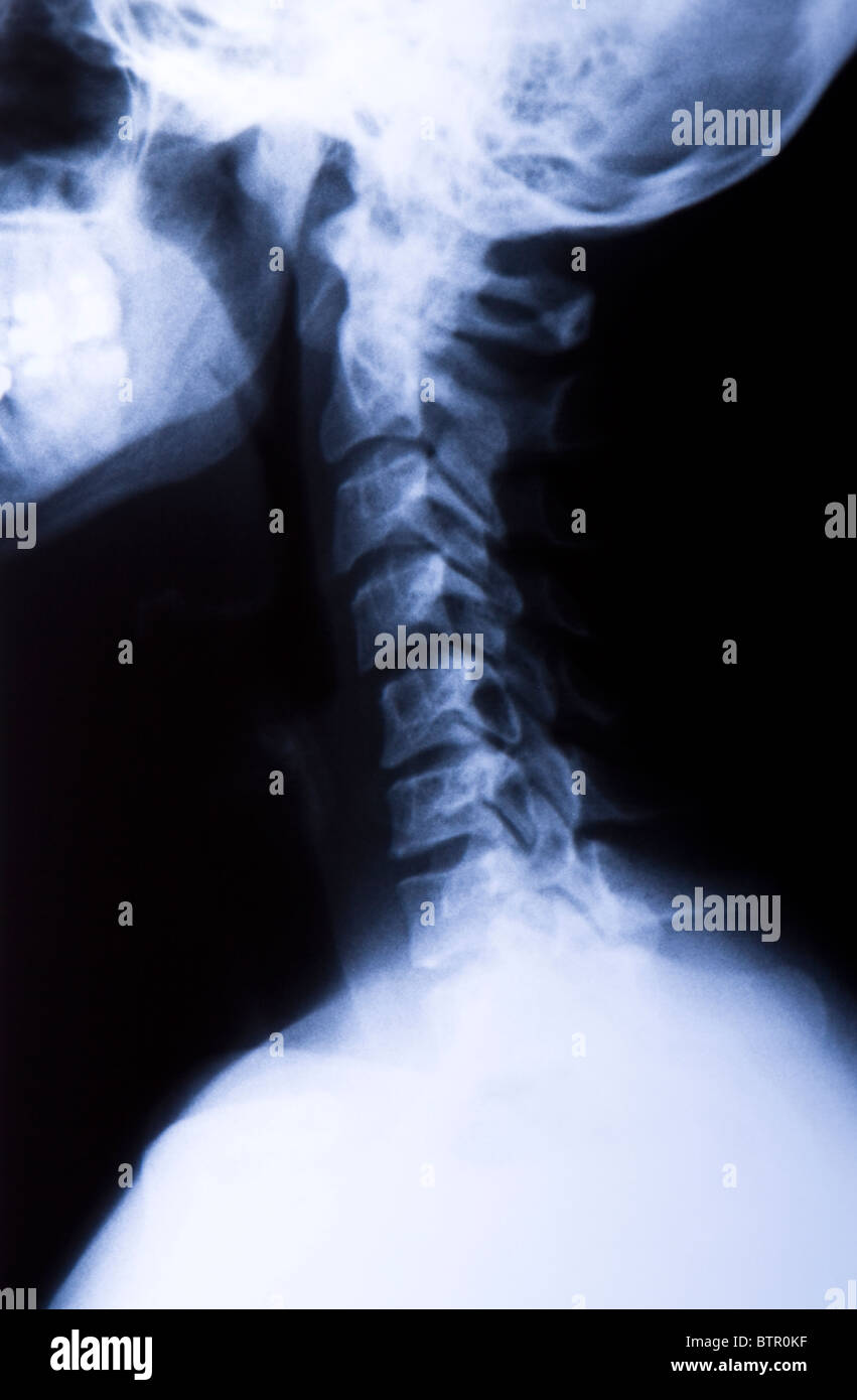 Side View of a neck X-Ray Stock Photo