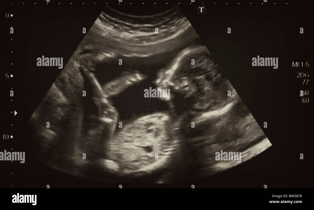Ultrasonography Analysis of a 4th Month Fetus, Italy Stock Photo