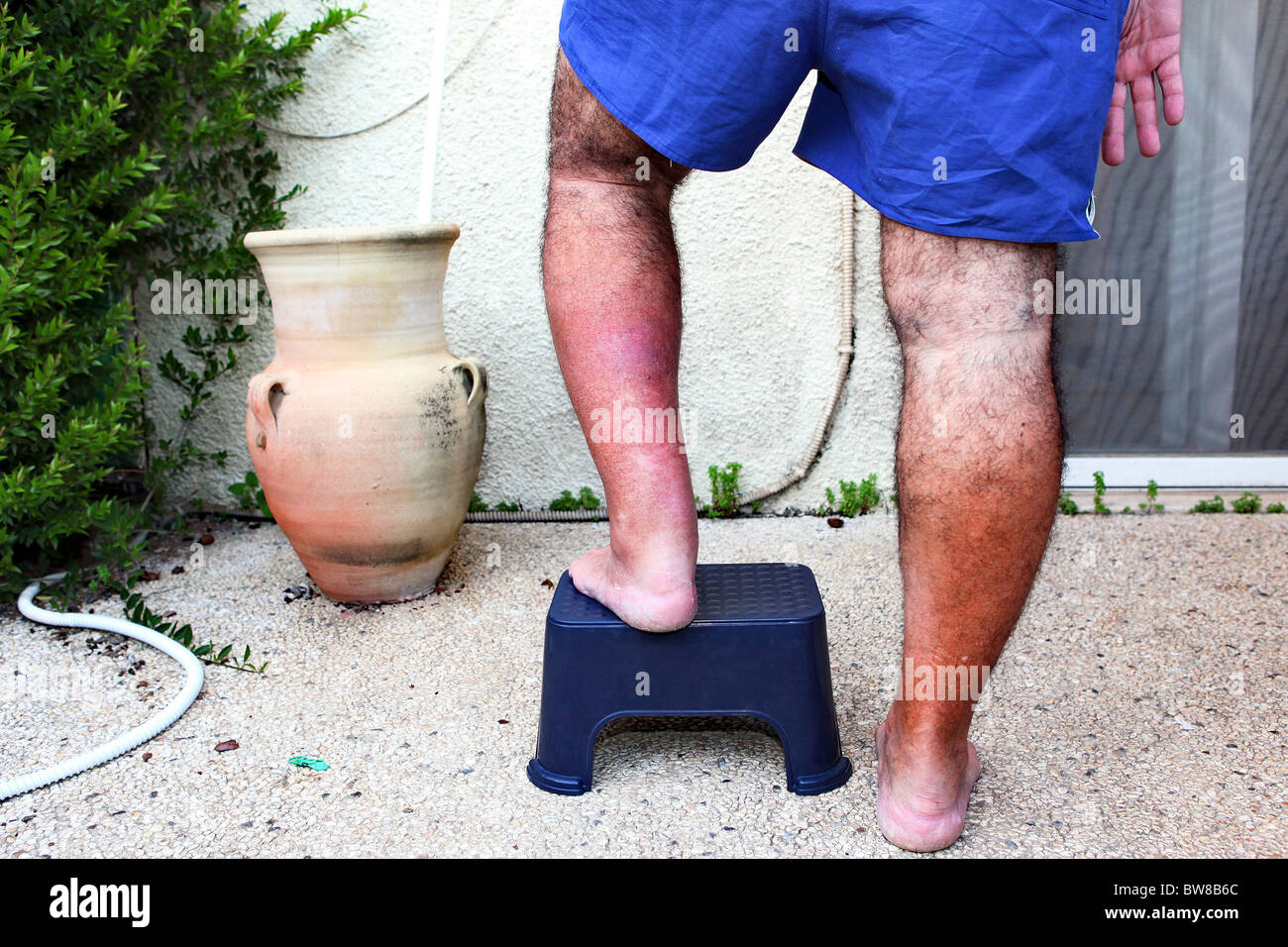 Erysipelas on leg. Close-up of swollen & inflamed skin of a young man Stock Photo