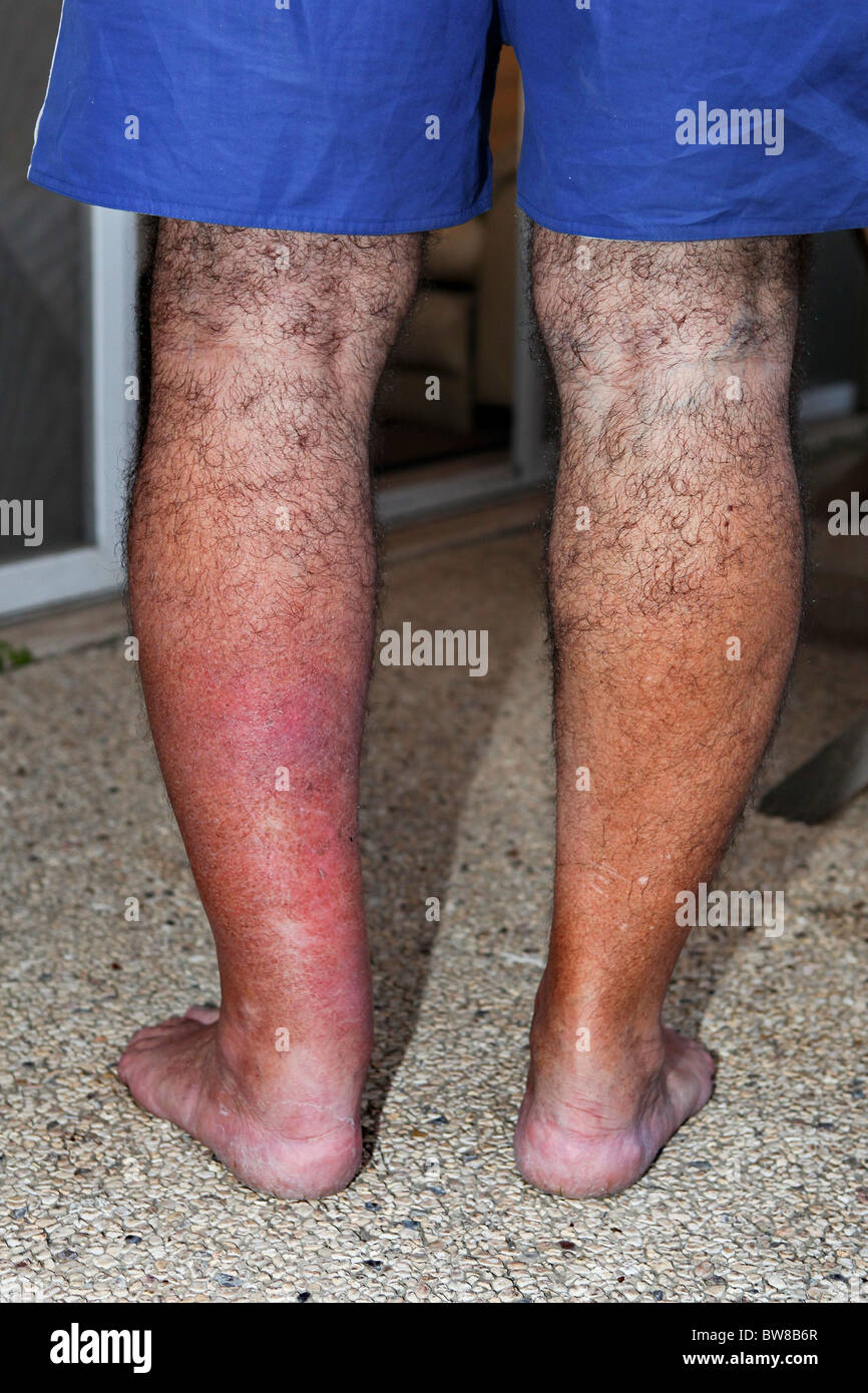 Erysipelas on leg. Close-up of swollen & inflamed skin of a young man Stock Photo