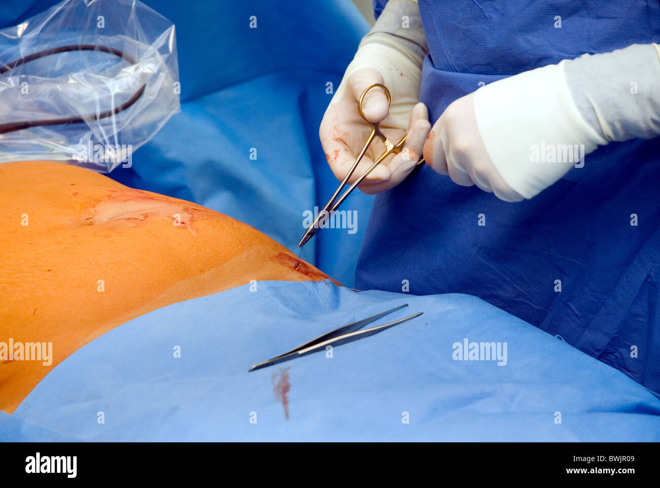 Surgeon sewing a wound after a laparoscopic intervention, Grevenbroich, Germany Stock Photo