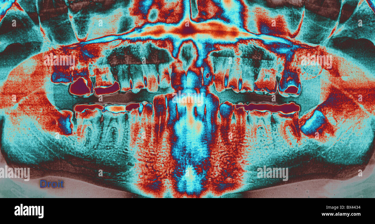medicine tooth medicine set of teeth teeth Xray Xray picture Stock